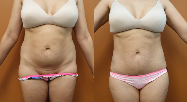 8741 - Liposuction Lower Back