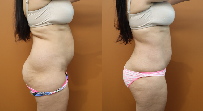 8741 - Side View Liposuction Lower Back