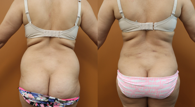 8741 - Back View Liposuction to Lower Back