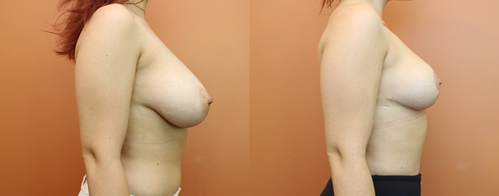 Breast Reduction — Side View — 650g Removed