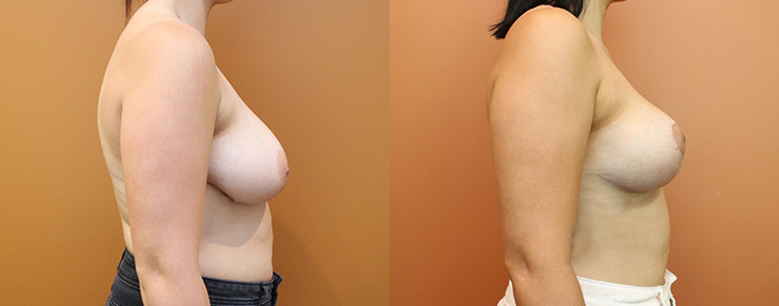 Breast Lift Without Implants — Side View