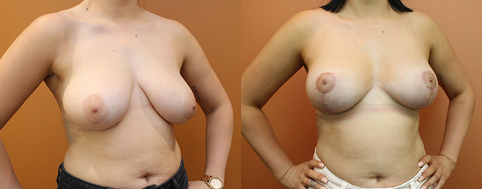 Breast Lift Without Implants — Angle View