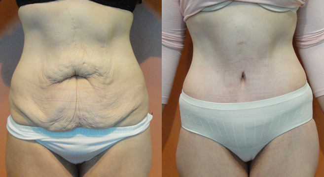 Extended Abdominoplasty Patient 1 — Front View