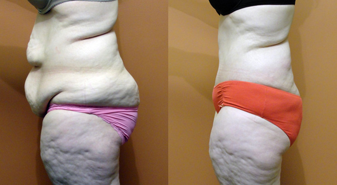 Extended Abdominoplasty Patient 3 — Side View