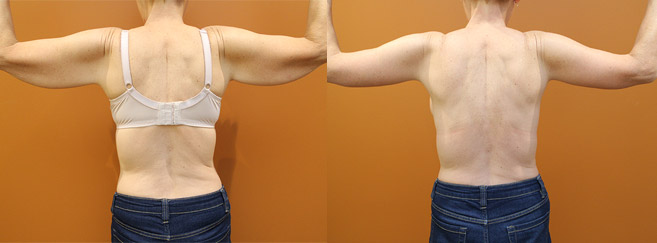 Arm lift before and after