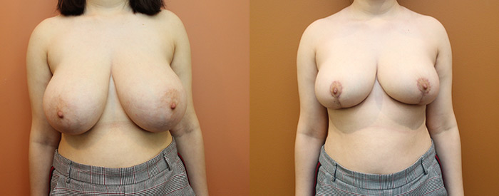 Breast Reduction — Front View — 1.3kg Removed