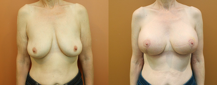 Breast Lift With Implants — 195cc Anatomical Sub Pect — Front View