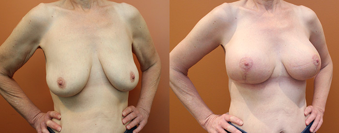 Breast Lift With Implants — 195cc Anatomical Sub Pect — Side View