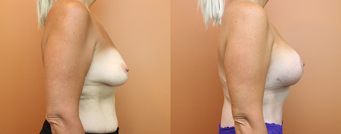 Breast Lift With Implants — 300cc Anatomical Sub Pect — Side View