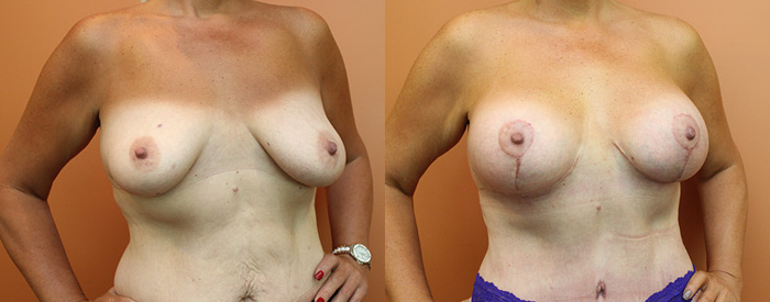 Breast Lift With Implants — 300cc Anatomical Sub Pect — Angle View
