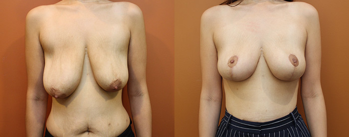 Breast Lift Without Implants — Front View