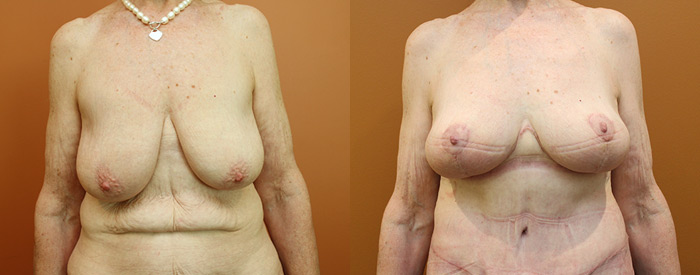 Breast Lift Without Implants — Front View
