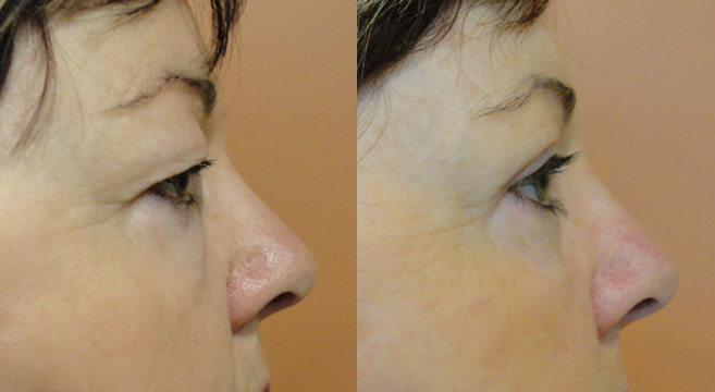 Upper Eyelids Surgery Patient 1 — Side View