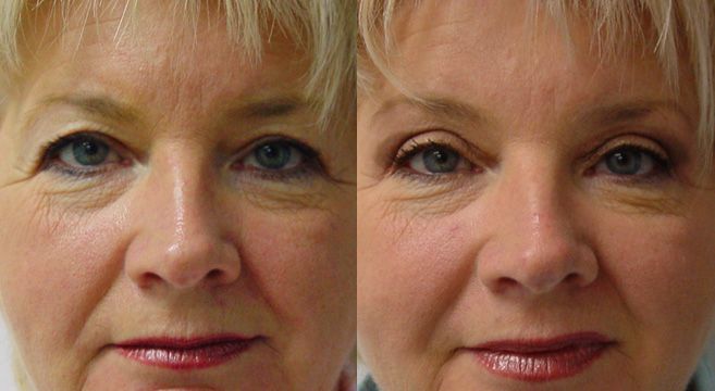 Upper Eyelids Surgery Patient 3 — Front View