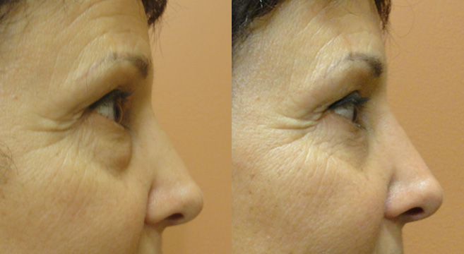 Lower Eyelids Surgery Patient 4 — Side View