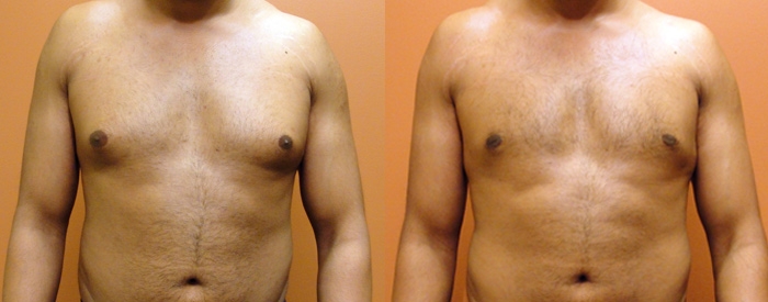 Gynaecomastia Surgery with Dr Jake Lim