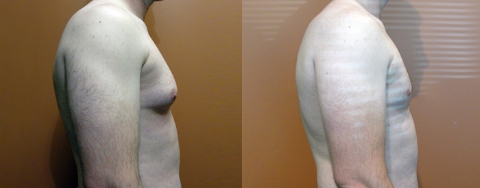 Gynaecomastia Patient 2 — Side View