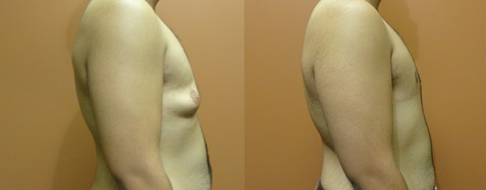Gynaecomastia Patient 4 — Side View