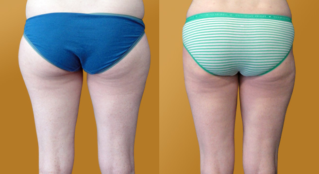 Liposuction Patient 1 — Back View