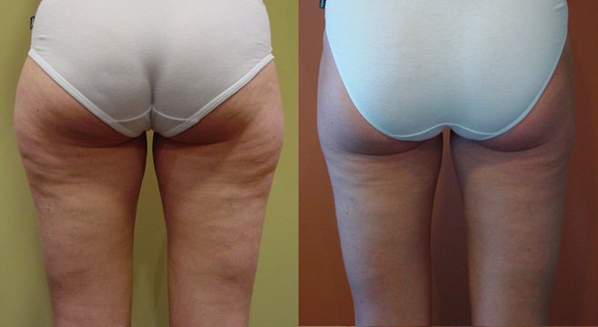 Liposuction Patient 2 — Back View