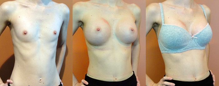 Breast Augmentation Patient 9 - 370cc Teardrop Implants