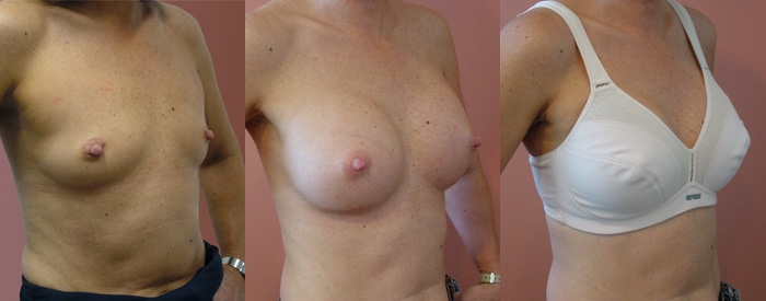 Breast Augmentation Patient 45 - 335cc Round Implants Under Muscle