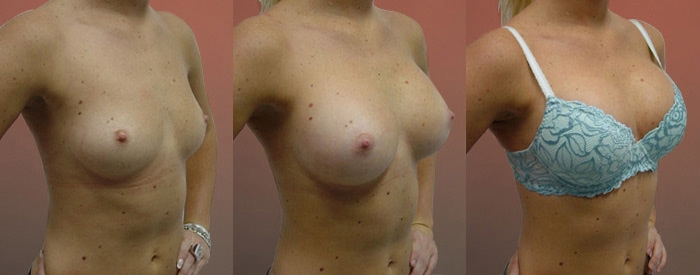 Breast Augmentation Patient 52 - 295cc Tear Drop Implants Under Muscle