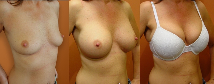 Breast Augmentation Patient 53 - 435cc Round Implants Under Muscle