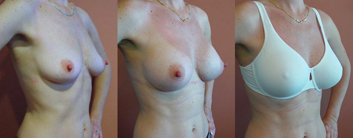 Breast Augmentation Patient 55 - 295cc Round Implants Above Muscle