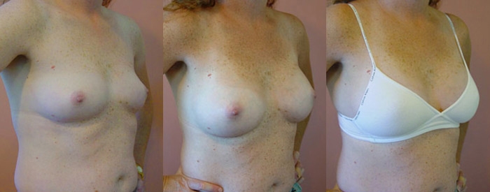 Breast Augmentation Patient 60 - 290cc Round Implants Above Muscle