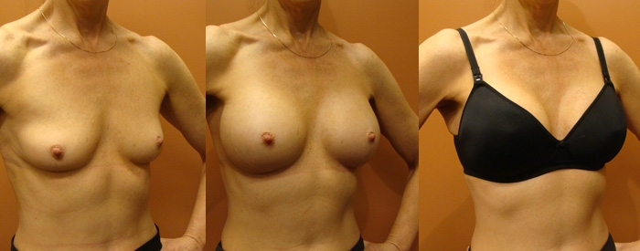 Breast Augmentation Patient 66 - 335cc Round Implants Under Muscle