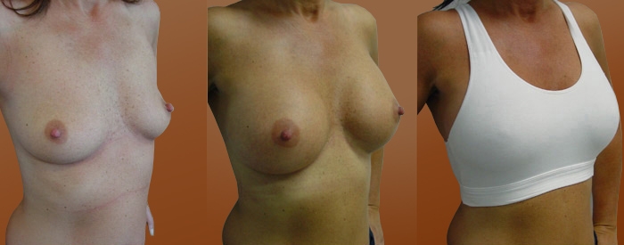 Breast Augmentation Patient 71 - 390cc Round Implants Under Muscle