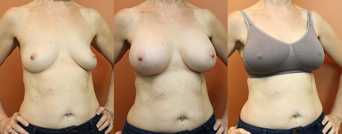 Breast augmentation — 390cc teardrop implants