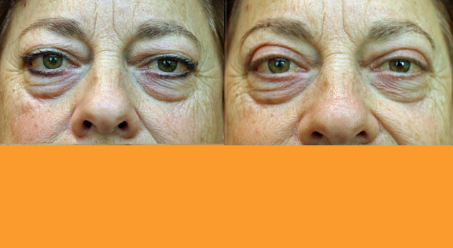 Eyelid Surgery — Front View