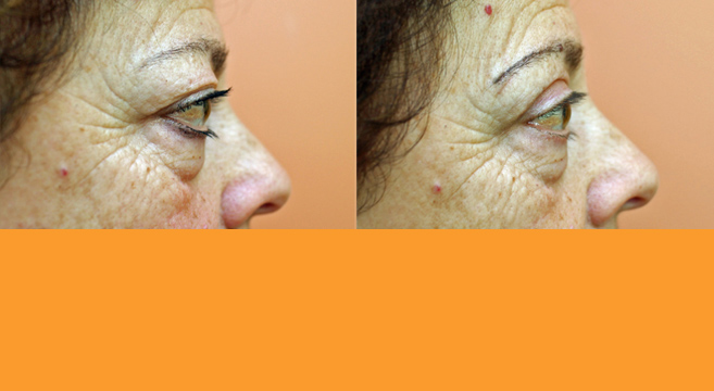 Eyelid Surgery — Side View