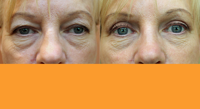 Upper Eyelid Surgery — Front View