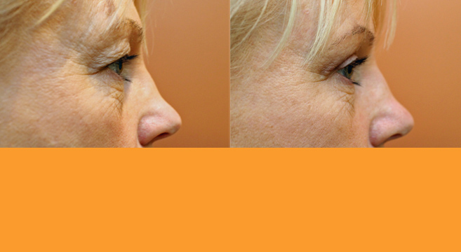 Upper Eyelid Surgery — Side View