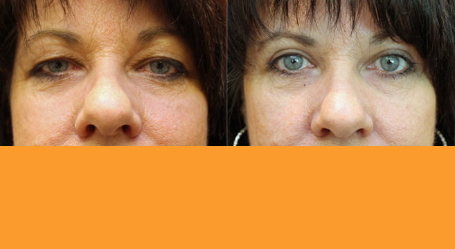 Upper Eyelid Surgery — Front View