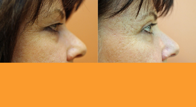 Upper Eyelid Surgery — Side View