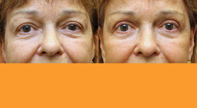 Eyelid Surgery — Front View