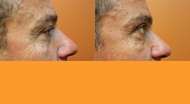 Eyelid Surgery — Side View