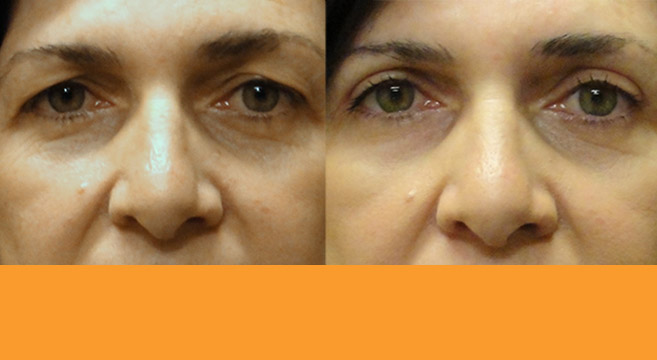 Upper Eyelids Surgery Patient 2 — Front View