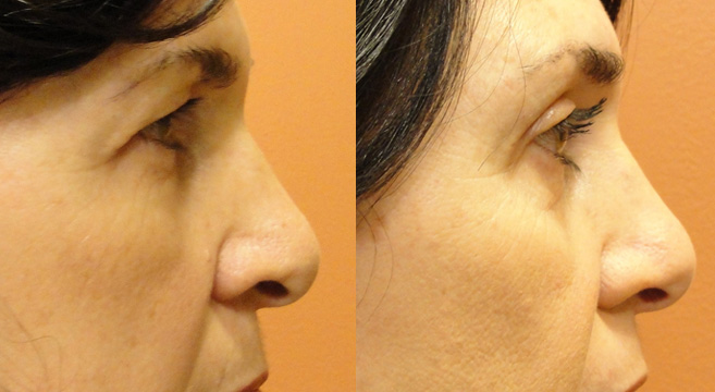 Upper Eyelids Surgery Patient 2 — Side View