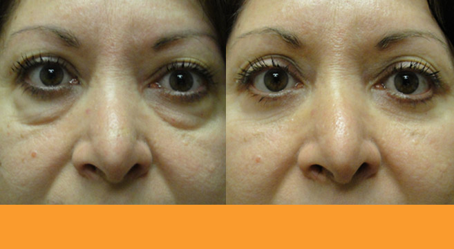 Lower Eyelids Surgery Patient 5 — Front View