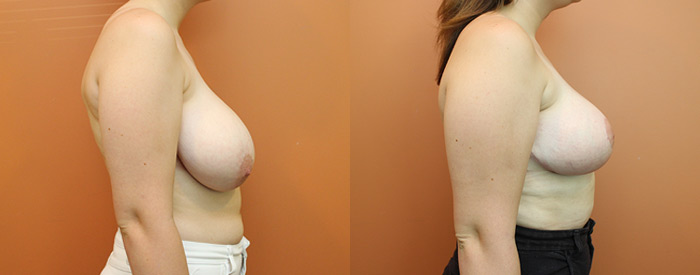 Breast Reduction — Side View — 900g Removed