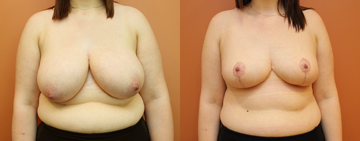 Breast Reduction — Front View — 1.3kg Removed
