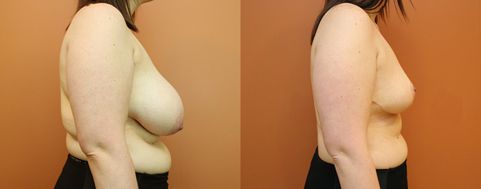 Breast Reduction — Side View — 1.3kg Removed