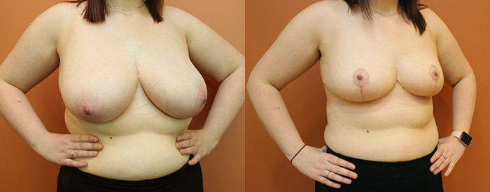 Breast Reduction — Angle View — 1.3kg Removed