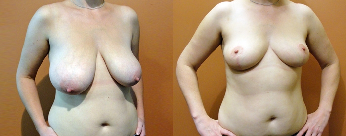Breast Reduction — Angle View