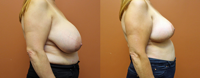 Breast Reduction — Front View